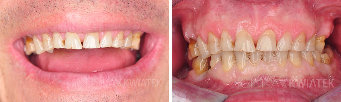Anwendung von prothetischen Kronen beim Patienten - Foto vor und nach dem Eingriff - Kwiatek Klinik Poznań